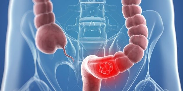 Riesgos y consecuencias del Síndrome de Intestino Irritable